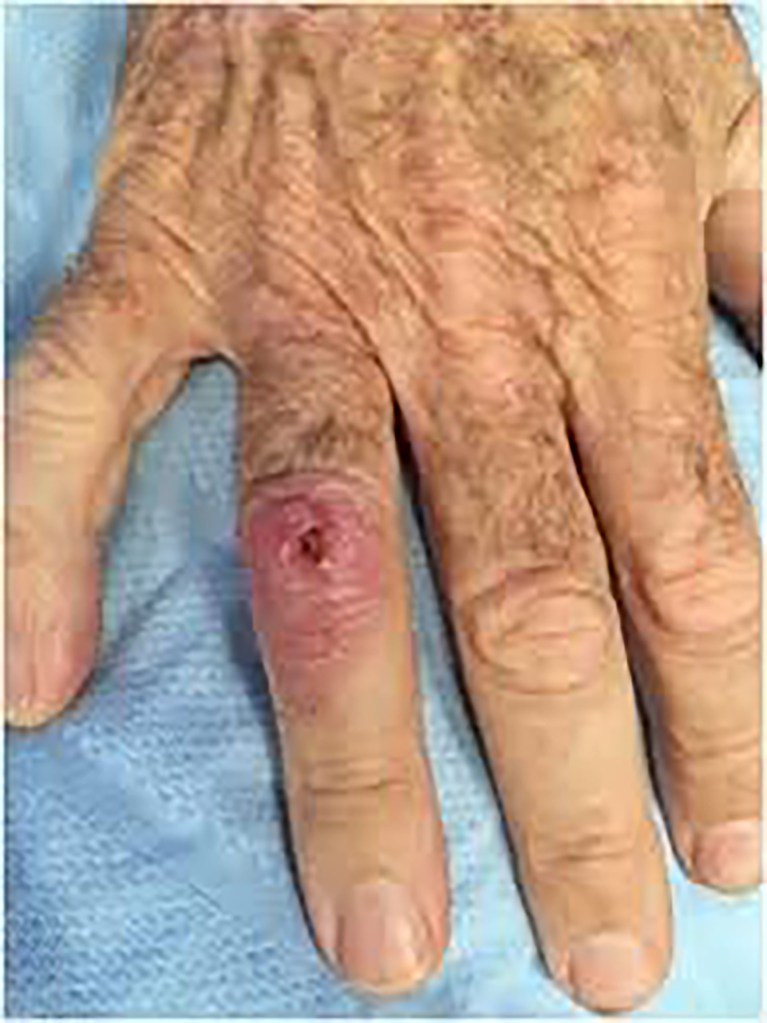 A hand with a visible cut, symbolizing the unknown and underdiagnosed disease melioidosis